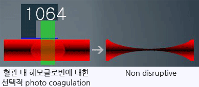 혈관치료