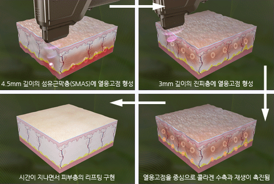 울트라포머 시술원리