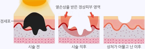 일반적인 점빼기