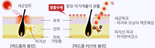 PDT 시술의 원리